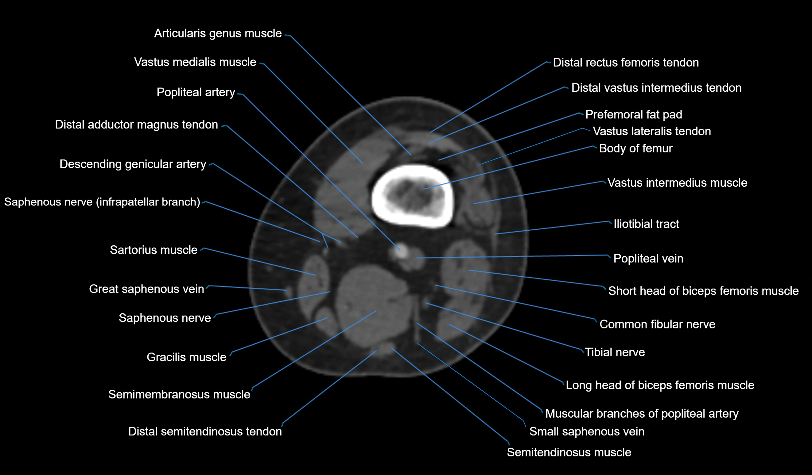 CT knee axial cross sectional anatomy labelled image-00010.webp